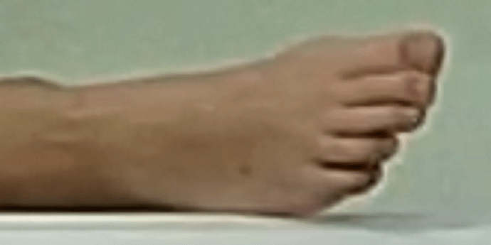 foot Dilara 6-13-22