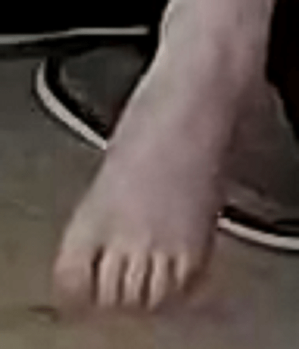 foot Debby 6-4-22