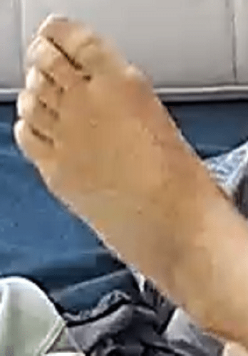 foot Auriel 5-20-22 1