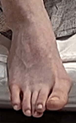 foot Astrid 5-16-22