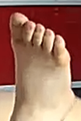 foot Alana 7-13-22 3