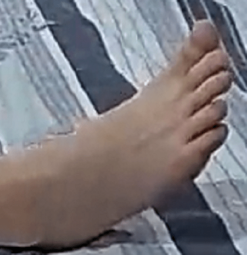 foot Barbara 5-22-22 1