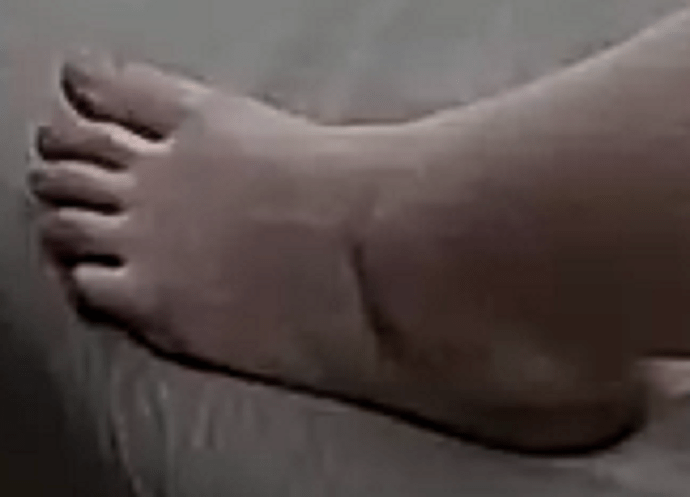 foot Indira 5-23-22