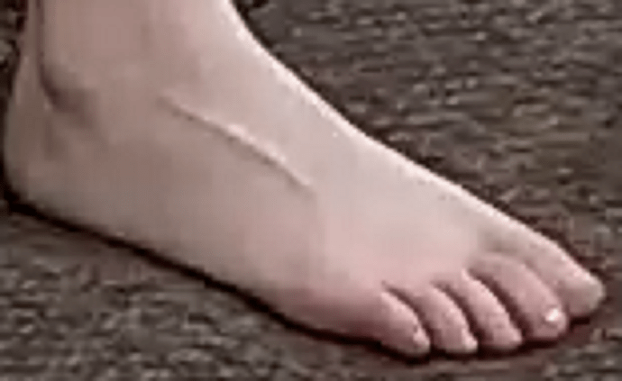 foot Alisa 12-22-22 2