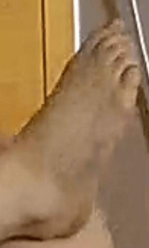 foot Demithra 5-16-22 3