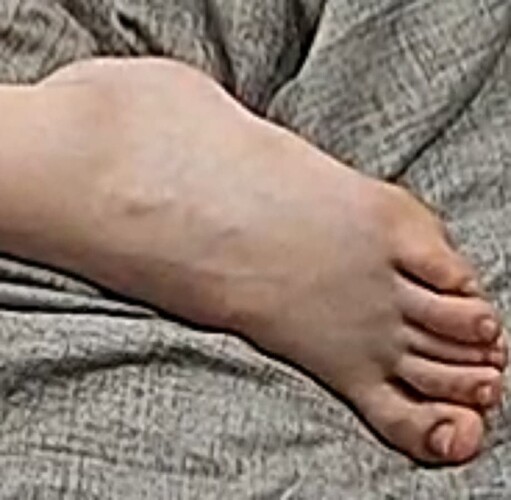 foot Astrid 7-3-22