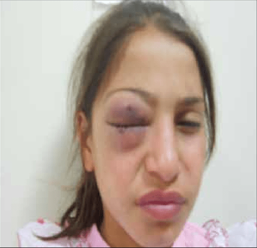 A-12-year-old-girl-presented-with-a-swelling-around-her-right-eye