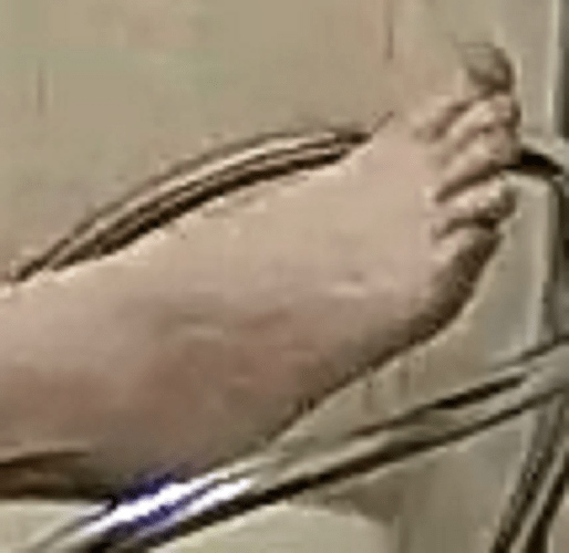 Debby foot 3-30-22