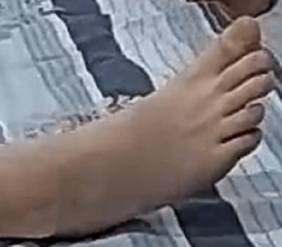 foot Barbara 5-22-22 2