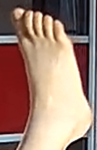 foot Alana 7-13-22 5